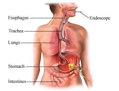 Percutánna endoskopická gastrostómia (PEG)
